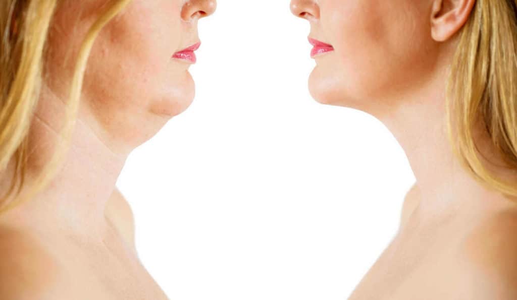 Double Chin treatment Yeovil before and after results