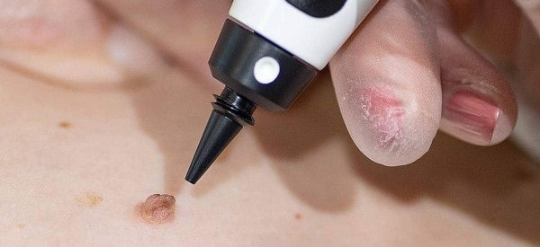 After Skin Tag Removal Yeovil