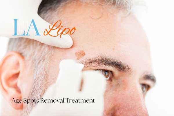 What Are the Most Effective Treatments for Age Spots Yeovil?