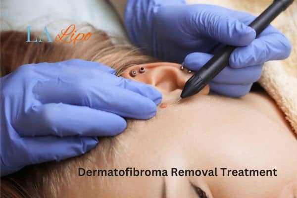 Dermatofibroma Removal Treatment Yeovil