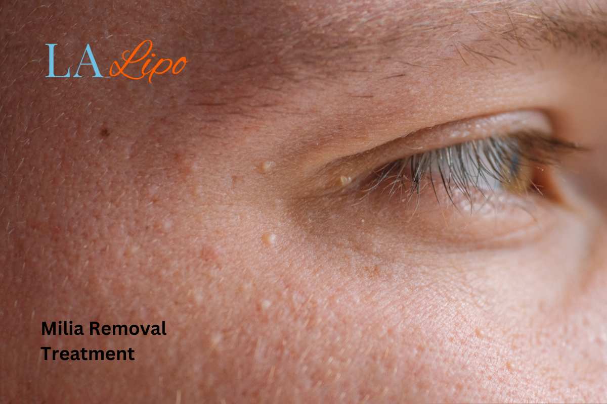 Cryopen Milia Removal: Is It the Easiest and Safest Option Yeovil?