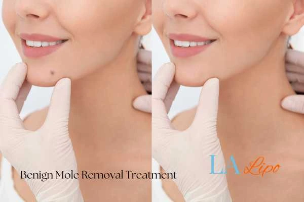 woman's before and after mole removal Yeovil results