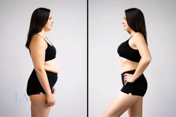 image of woman before and after results of LA-EMS Body Sculpting Yeovil to help treat Diastasis recti
