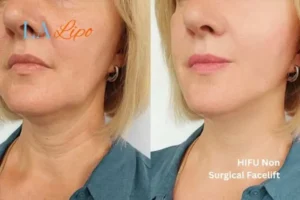 hi-fu for wrinkles Yeovil before and after results
