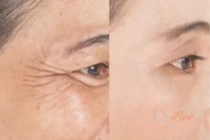 Before and after results of woman - HI-fu wrinkles reduction treatment Yeovil