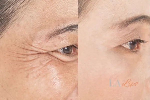 Before and after results of woman - HI-fu wrinkles reduction treatment Yeovil