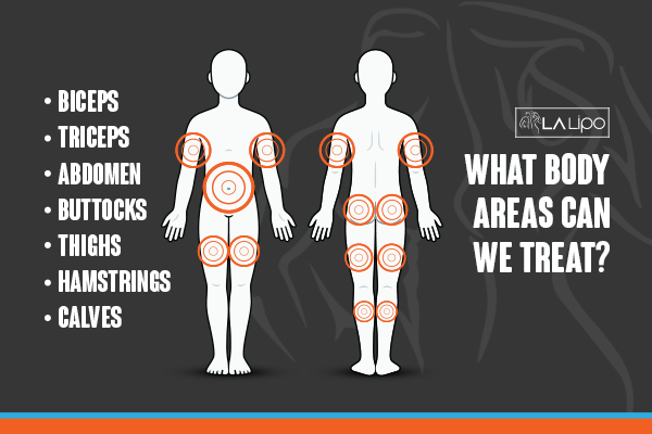 Graphic to show areas you can have LA-EMS Body Sculpting Yeovil treatment.