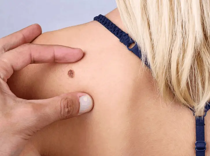woman having mole removal Yeovil consultation before treatment.