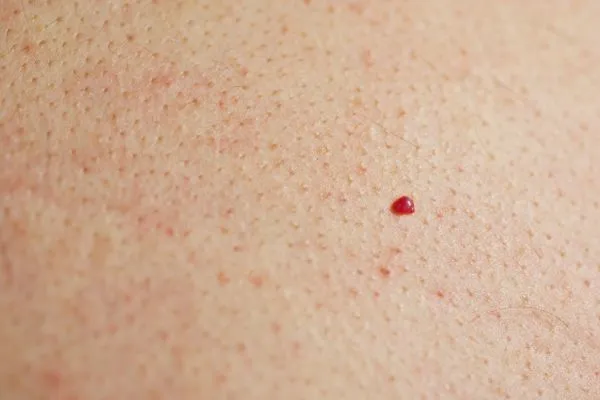 close up of a cherry angioma Yeovil
