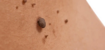 image of a skin tag Yeovil