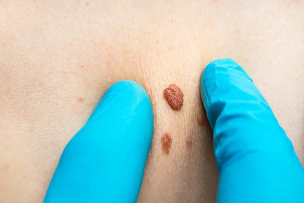 Consultant examining a skin tag Yeovil