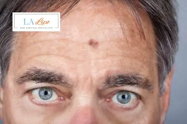 Solar Lentigo Removal Yeovil image of man with mark on his forehead