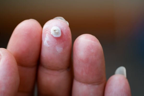 wart on person finger - cryotherapy to treat from LA LIPO Yeovil