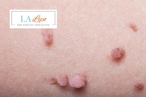Does cryopen skin tag removal Yeovil hurt? Find out now call our team today!