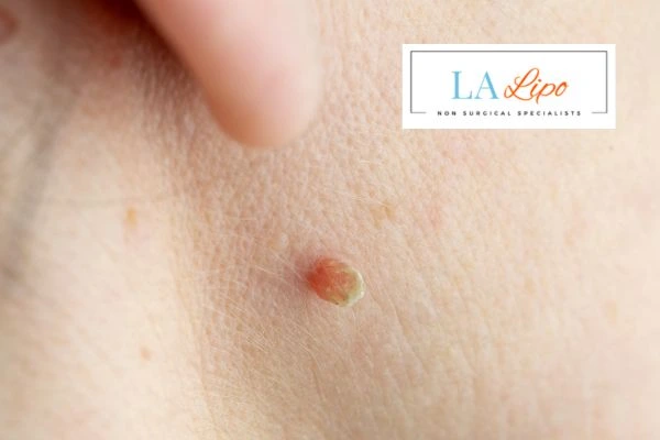 Book skin tag removal Yeovil today speak to our team now!