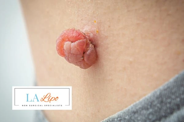 Interested in skin tag removal Yeovil? Concerned about the pain? Find out more today!