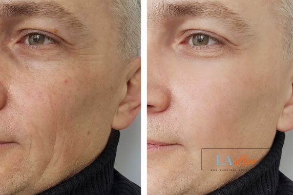 See the amazing results of Morpheus8 Treatment Yeovil!