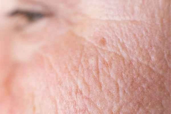 close up picture of a woman's face showing an age spot Yeovil