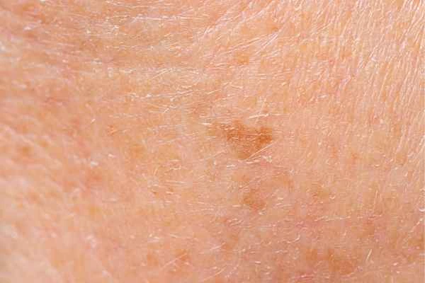 close up picture of age spots Yeovil