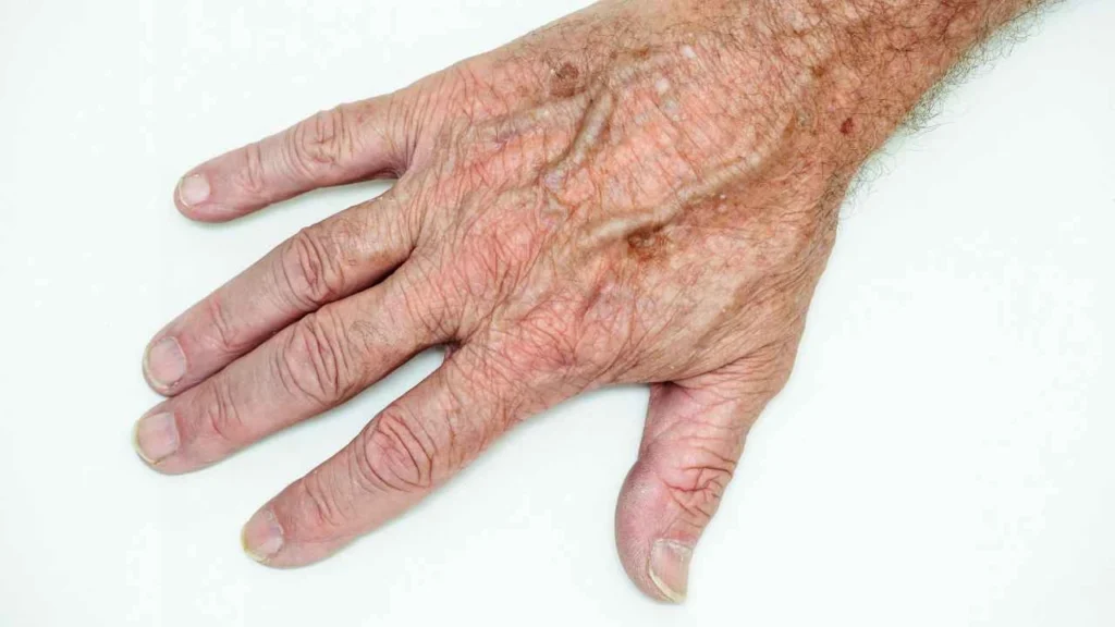 Male hand showing age spot Yeovil