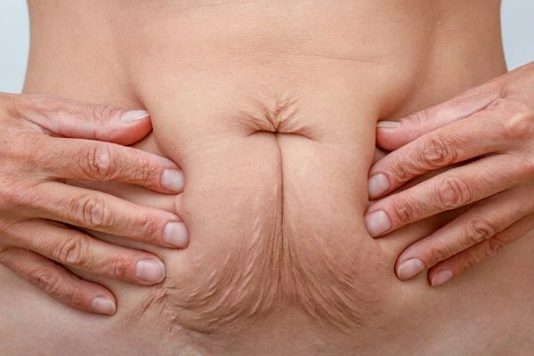 Image of a woman's stomach with loose skin - example of skin tightening Yeovil options