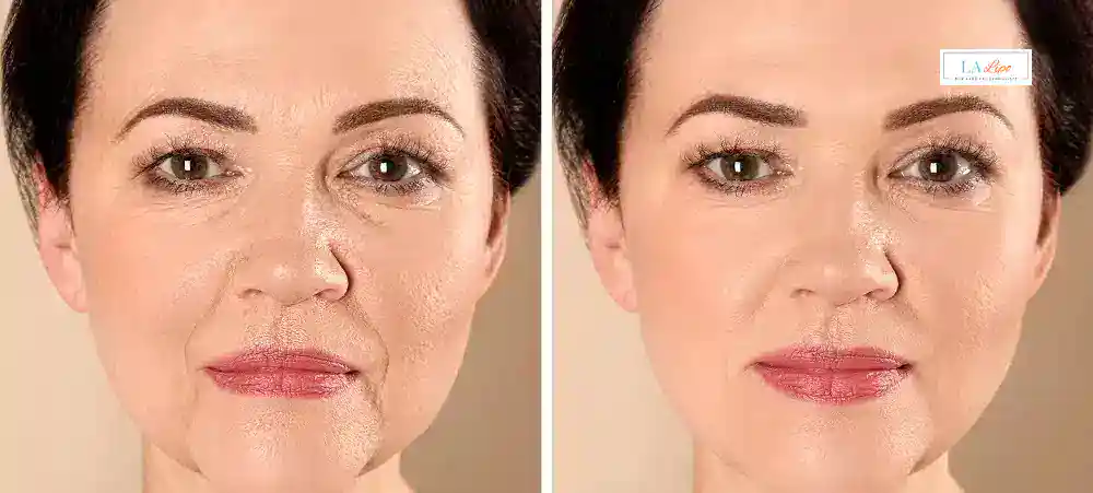How Long Does It Take to See Results and How Long Do They Last Yeovil?