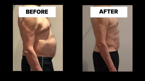 What Symptoms Can Diastasis Recti Cause in Men? Weak Core, Back Pain and Poor Posture Yeovil